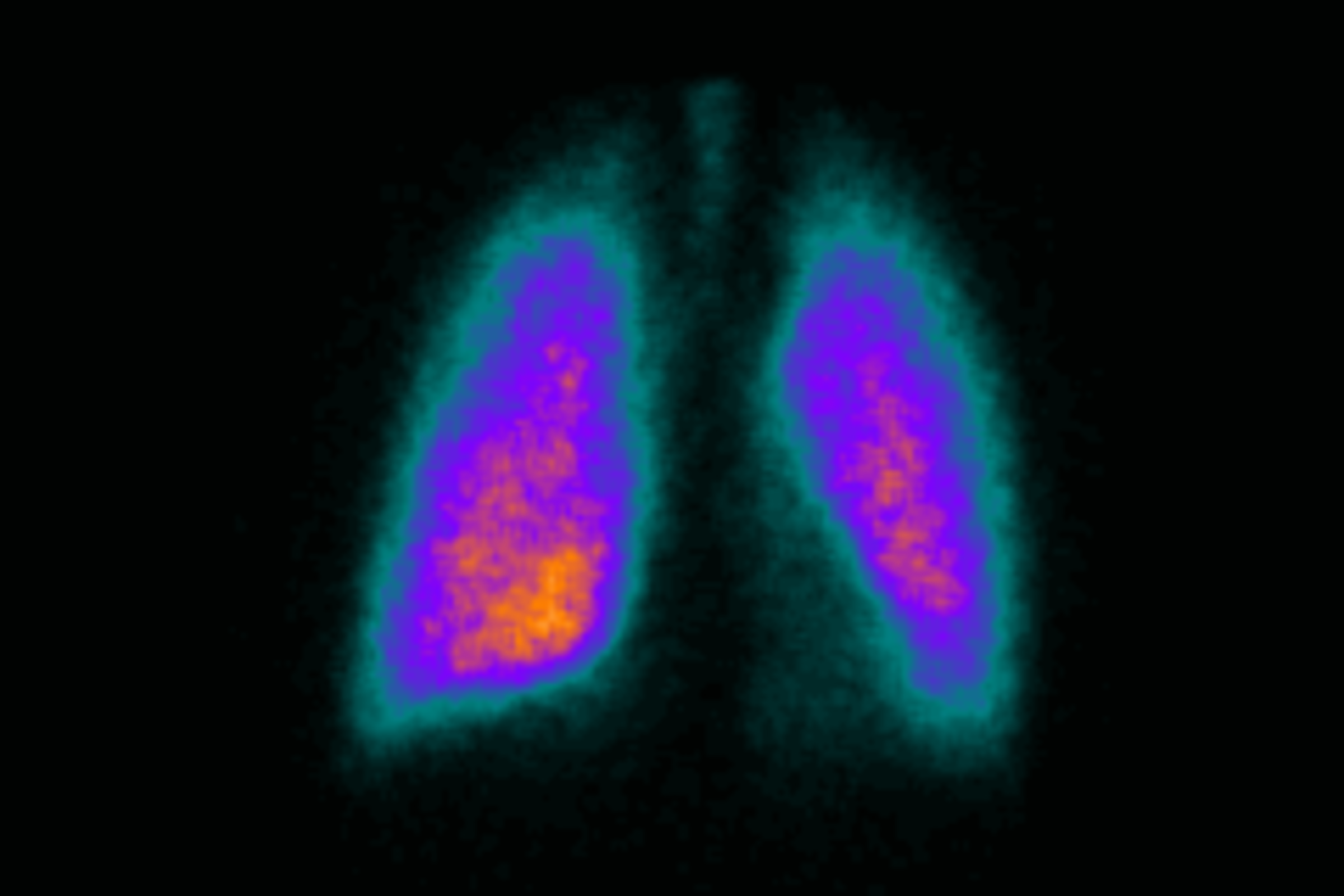 A scintigraphy study of budesonide/ glycopyrrolate/formoterol fumarate metered dose inhaler in patients with moderate-to-very severe chronic obstructive pulmonary disease.