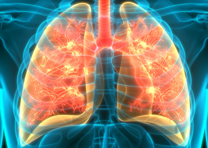 Image of affected lungs