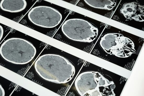 Image of Xray showing sections of the Brain